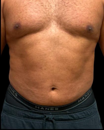 Liposuction Before & After Patient #6978