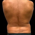 Liposuction Before & After Patient #6978