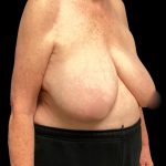 Bilateral Breast Reduction Before & After Patient #7032
