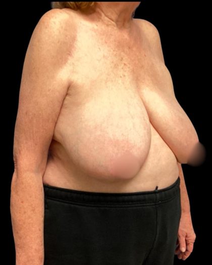 Bilateral Breast Reduction Before & After Patient #7032