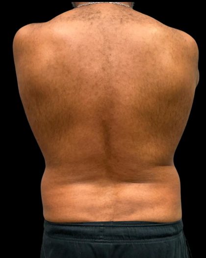 Liposuction Before & After Patient #6978