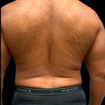 Liposuction Before & After Patient #6978
