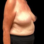 Bilateral Breast Reduction Before & After Patient #7032