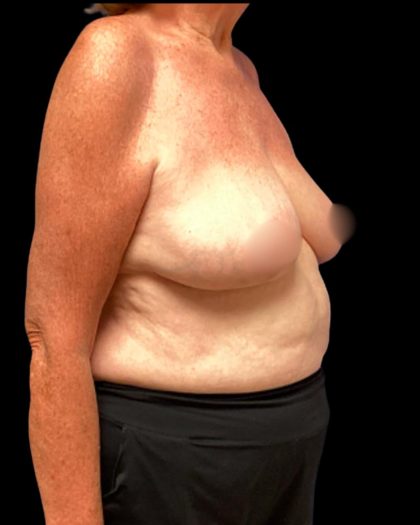 Bilateral Breast Reduction Before & After Patient #7032