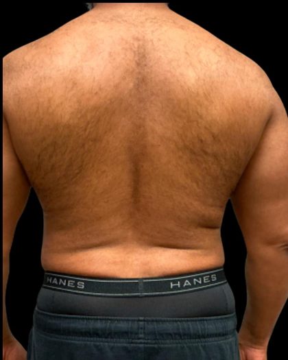 Liposuction Before & After Patient #6978