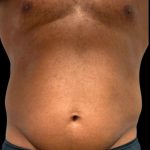 Liposuction Before & After Patient #6978