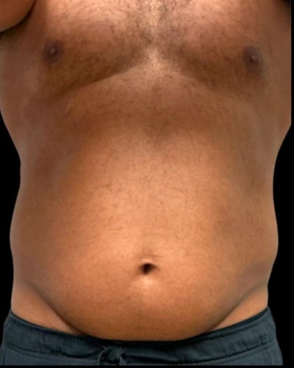 Liposuction Before & After Patient #6978