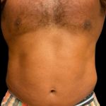 Liposuction Before & After Patient #6978