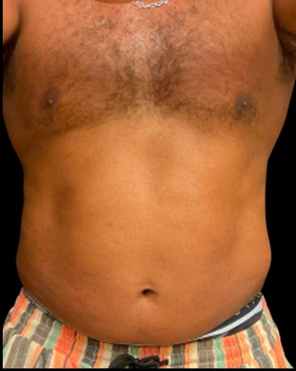 Liposuction Before & After Patient #6978