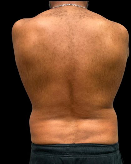 Liposuction Before & After Patient #6978