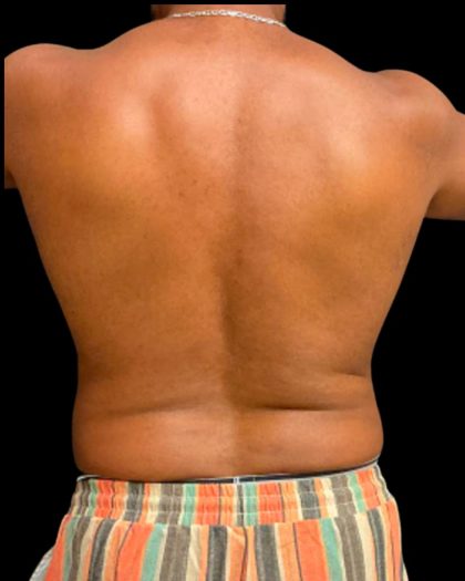 Liposuction Before & After Patient #6978