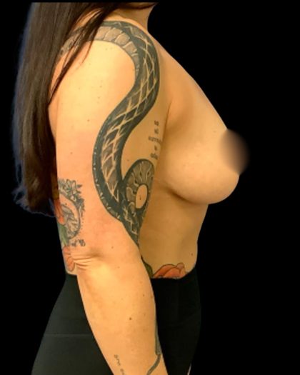 Liposuction Before & After Patient #7033