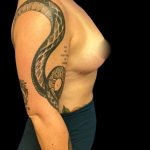 Liposuction Before & After Patient #7033