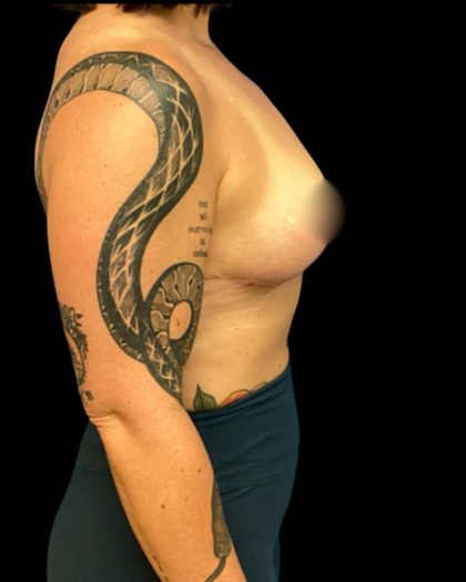 Liposuction Before & After Patient #7033