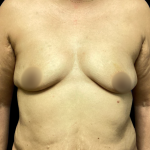 Breast Augmentation Before & After Patient #7284