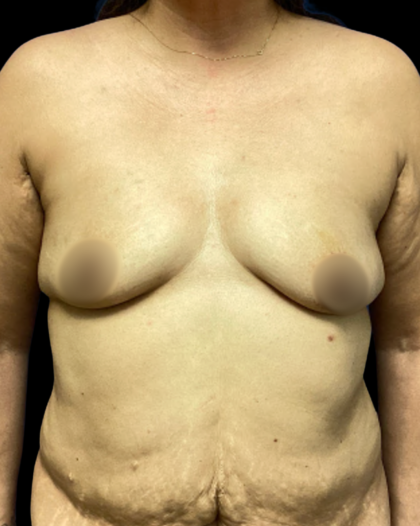 Breast Augmentation Before & After Patient #7284