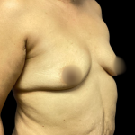 Breast Augmentation Before & After Patient #7284