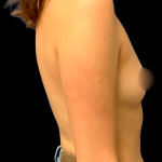 Breast Augmentation Before & After Patient #7394