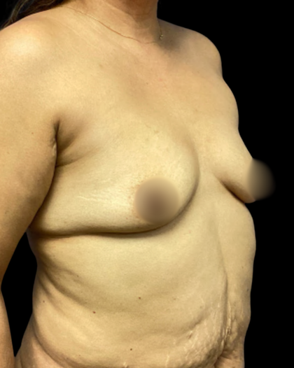Breast Augmentation Before & After Patient #7284