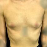 Breast Augmentation Before & After Patient #7395