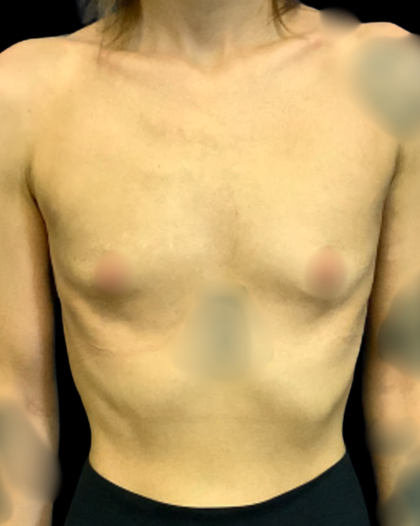Breast Augmentation Before & After Patient #7395