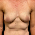 Breast Augmentation Before & After Patient #7350