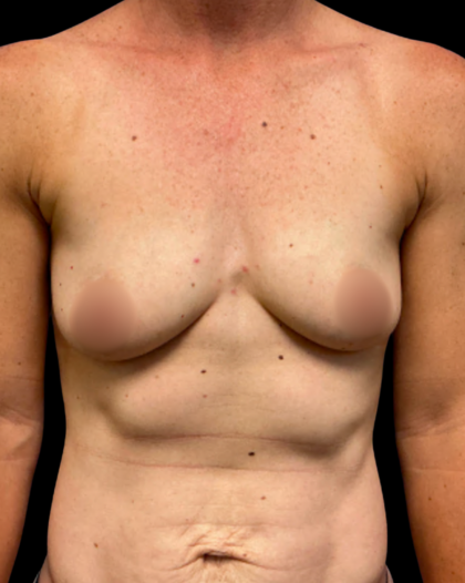 Breast Augmentation Before & After Patient #7350