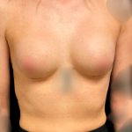 Breast Augmentation Before & After Patient #7395