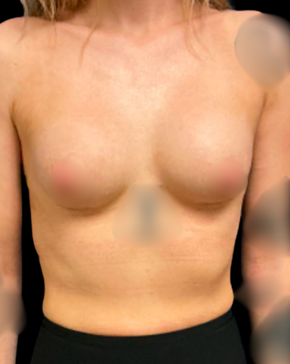 Breast Augmentation Before & After Patient #7395
