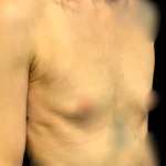 Breast Augmentation Before & After Patient #7395