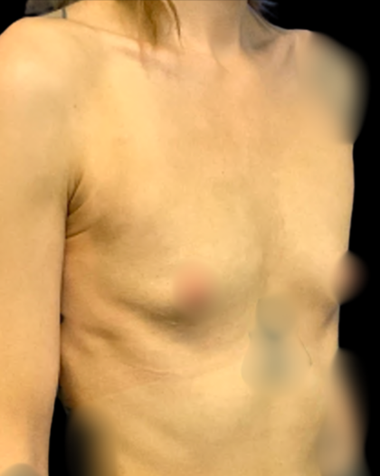 Breast Augmentation Before & After Patient #7395