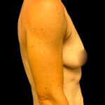 Breast Augmentation Before & After Patient #7350