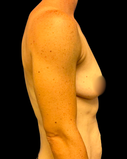 Breast Augmentation Before & After Patient #7350