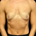 Breast Augmentation Before & After Patient #7351
