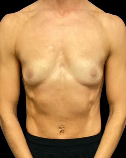 Breast Augmentation Before & After Patient #7351
