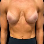 Breast Augmentation Before & After Patient #7351