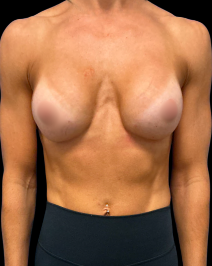 Breast Augmentation Before & After Patient #7351