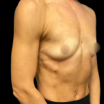 Breast Augmentation Before & After Patient #7351