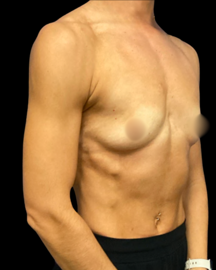 Breast Augmentation Before & After Patient #7351