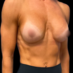 Breast Augmentation Before & After Patient #7351
